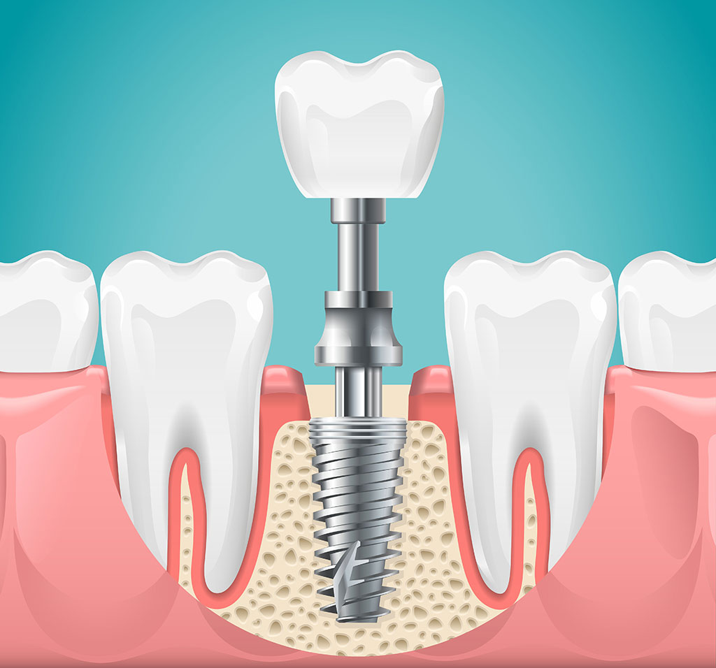 As a treatment method recognized by science for many years, implant surgery allows us to significantly expand our treatment range.