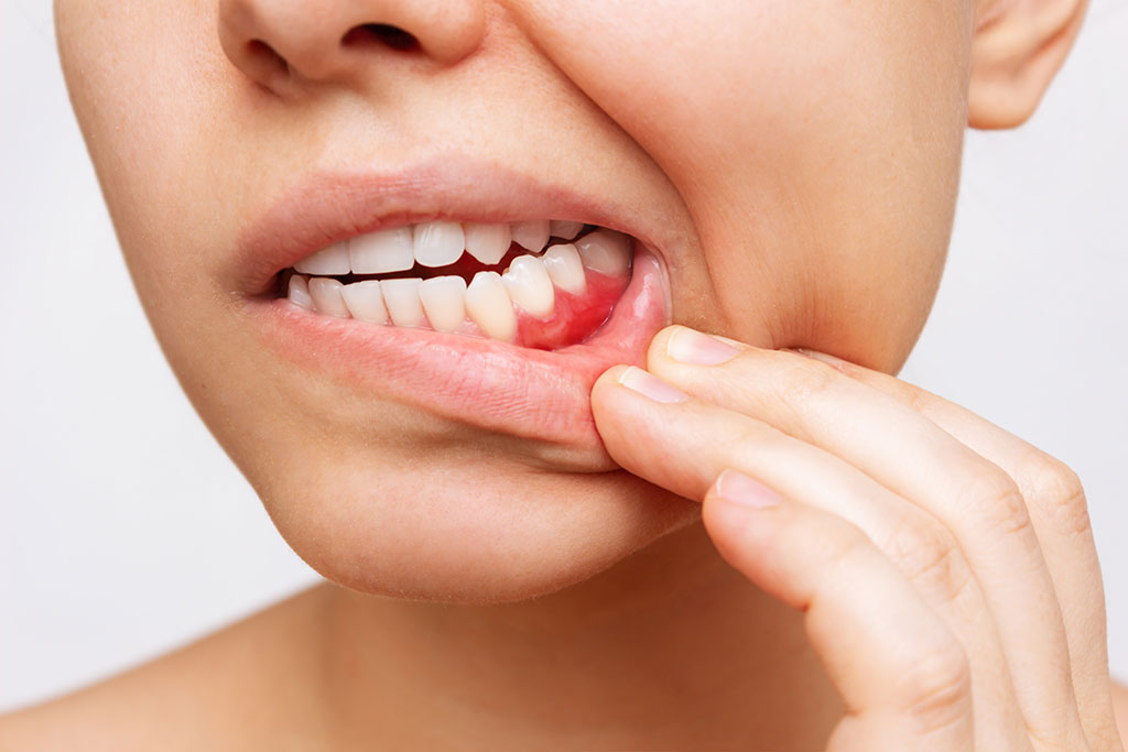 Periodontitis is an inflammation of the periodontium caused by bacteria, which eventually leads to loss of the tooth.
