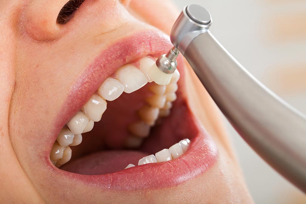 Die professionelle Zahnreinigung gilt in einer qualitätsorientierten Praxis als Hauptbestandteil der zahnmedizinischen Prophylaxe.